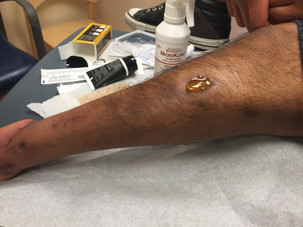 Honey Treatment for Nathan