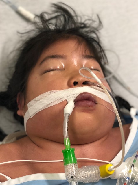 Lilyan Immediatley PostOp #3